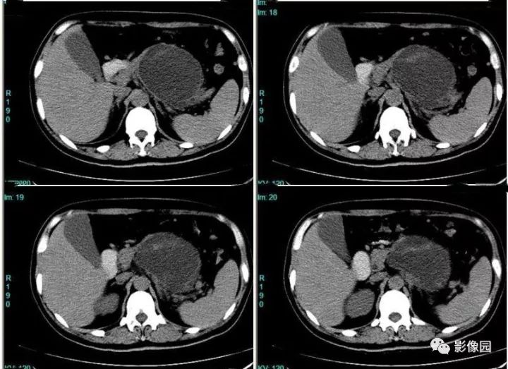 【病例】胰腺囊腺瘤，浆液性还是黏液性？