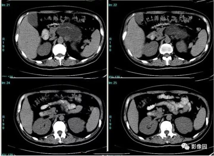 【病例】胰腺囊腺瘤，浆液性还是黏液性？