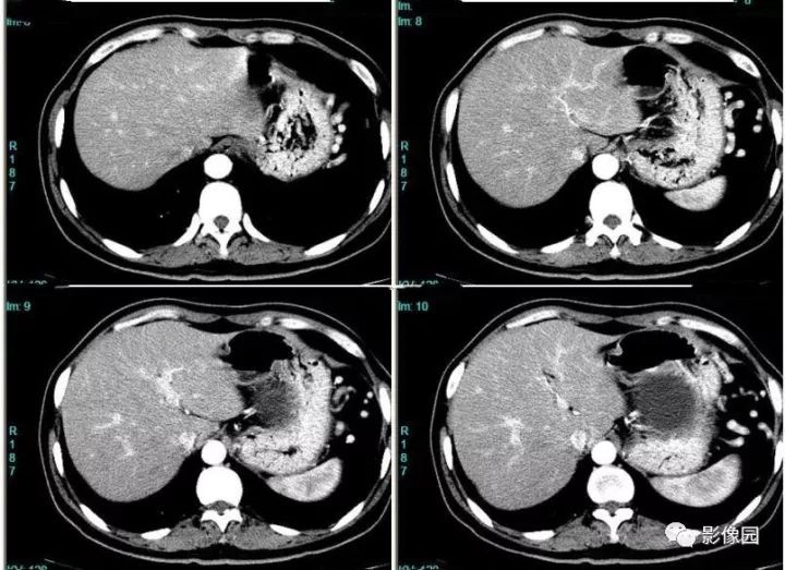 【病例】胰腺囊腺瘤，浆液性还是黏液性？