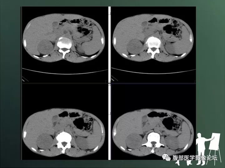 【病例】右肾透明细胞癌的不典型表现1例CT