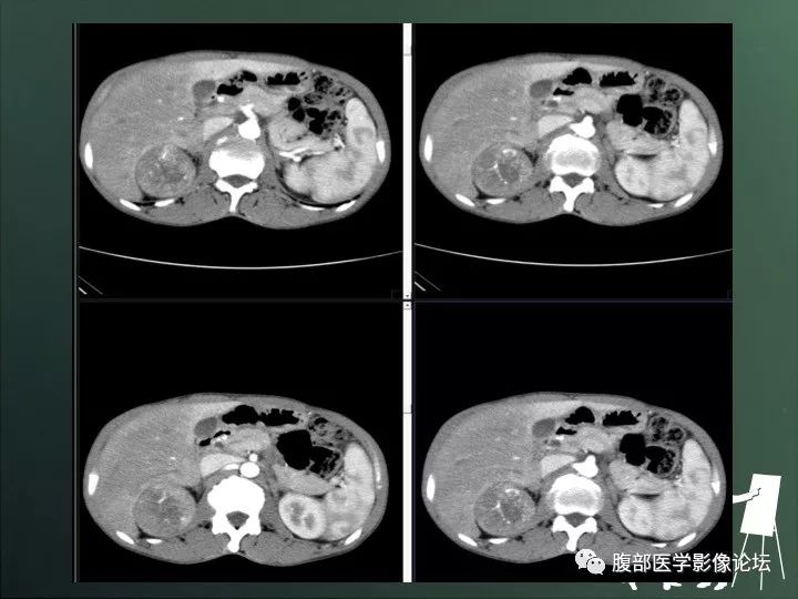 【病例】右肾透明细胞癌的不典型表现1例CT