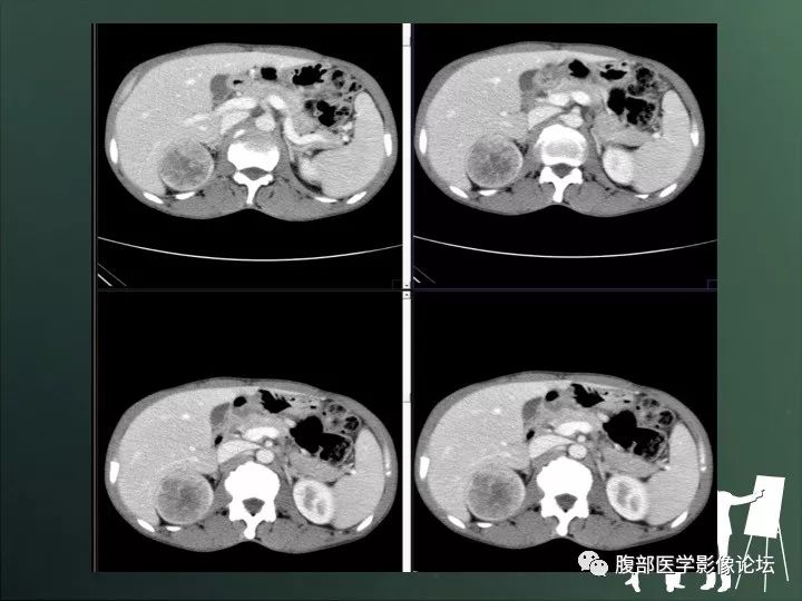 【病例】右肾透明细胞癌的不典型表现1例CT