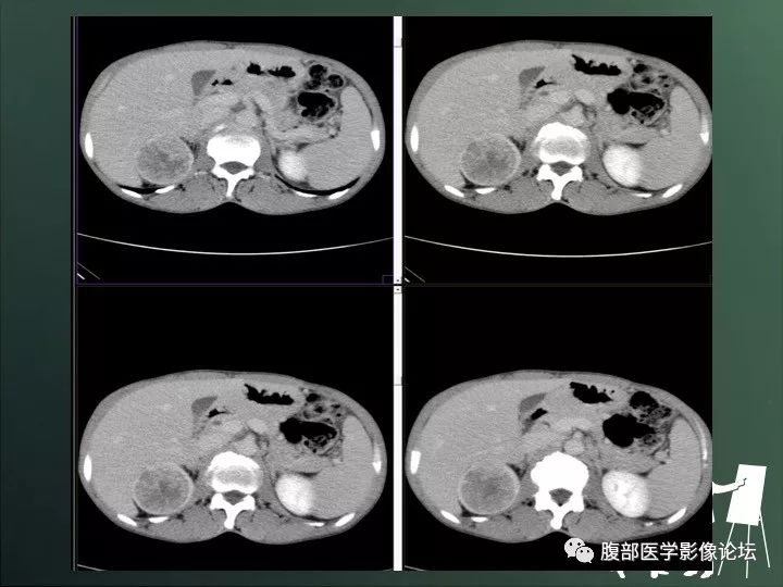 【病例】右肾透明细胞癌的不典型表现1例CT