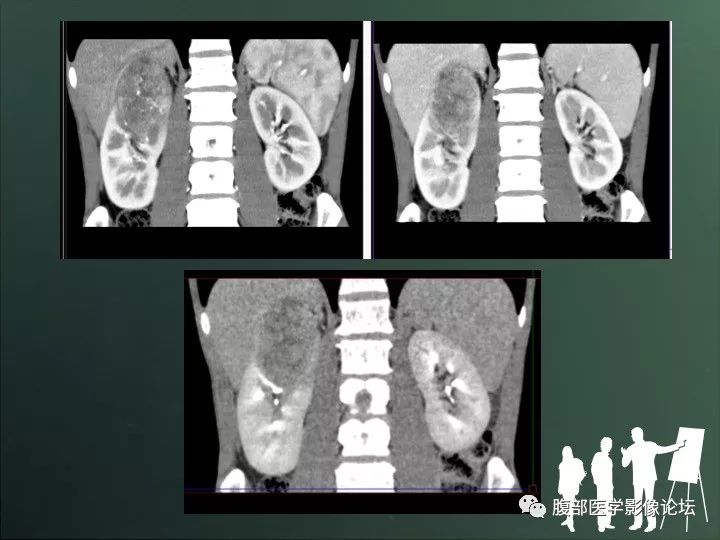 【病例】右肾透明细胞癌的不典型表现1例CT