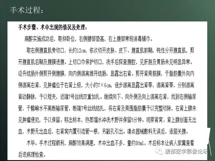 【病例】右肾透明细胞癌的不典型表现1例CT