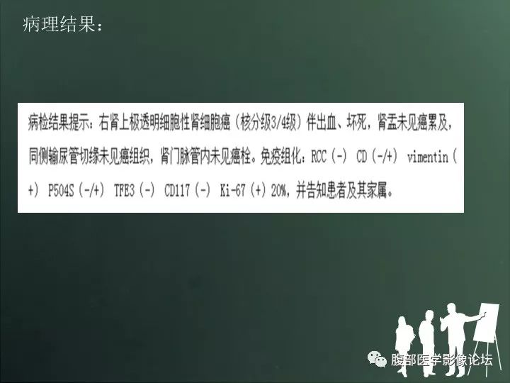 【病例】右肾透明细胞癌的不典型表现1例CT