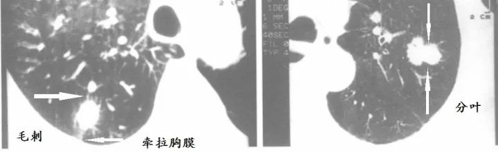 肺CT也会装酷:如何从CT上看出肺癌的病理类型? 肺CT也会装酷:如何从CT上看出肺癌的病理类型?