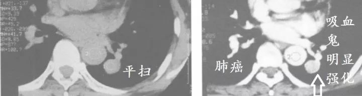 肺CT也会装酷:如何从CT上看出肺癌的病理类型? 肺CT也会装酷:如何从CT上看出肺癌的病理类型?