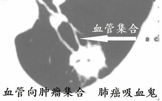 肺CT也会装酷:如何从CT上看出肺癌的病理类型? 肺CT也会装酷:如何从CT上看出肺癌的病理类型?