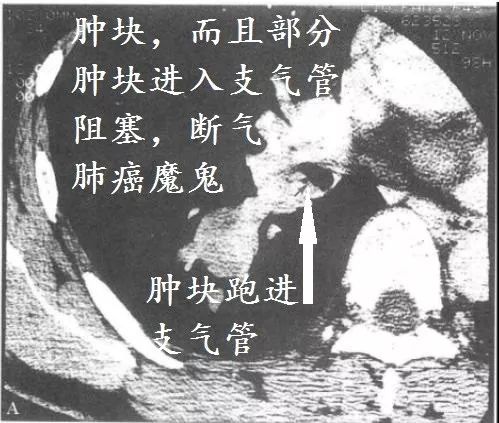 肺CT也会装酷:如何从CT上看出肺癌的病理类型? 肺CT也会装酷:如何从CT上看出肺癌的病理类型?