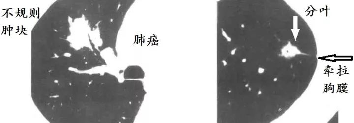 肺CT也会装酷:如何从CT上看出肺癌的病理类型? 肺CT也会装酷:如何从CT上看出肺癌的病理类型?