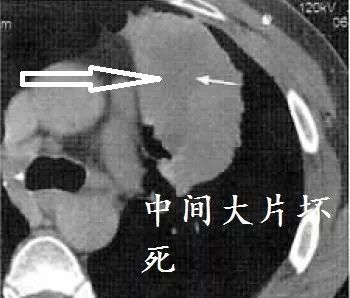 肺CT也会装酷:如何从CT上看出肺癌的病理类型? 肺CT也会装酷:如何从CT上看出肺癌的病理类型?