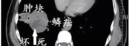 肺CT也会装酷:如何从CT上看出肺癌的病理类型? 肺CT也会装酷:如何从CT上看出肺癌的病理类型?