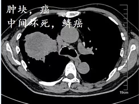 肺CT也会装酷:如何从CT上看出肺癌的病理类型? 肺CT也会装酷:如何从CT上看出肺癌的病理类型?