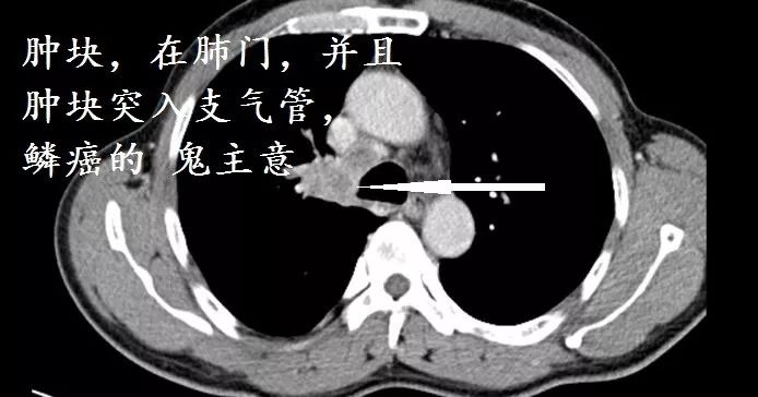 肺CT也会装酷:如何从CT上看出肺癌的病理类型? 肺CT也会装酷:如何从CT上看出肺癌的病理类型?