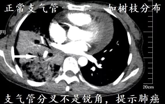 肺CT也会装酷:如何从CT上看出肺癌的病理类型? 肺CT也会装酷:如何从CT上看出肺癌的病理类型?