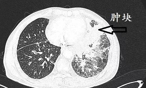 肺CT也会装酷:如何从CT上看出肺癌的病理类型? 肺CT也会装酷:如何从CT上看出肺癌的病理类型?