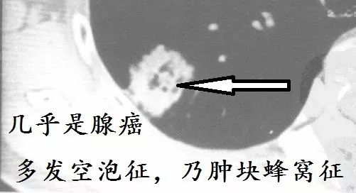 肺CT也会装酷:如何从CT上看出肺癌的病理类型? 肺CT也会装酷:如何从CT上看出肺癌的病理类型?