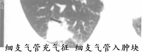 肺CT也会装酷:如何从CT上看出肺癌的病理类型? 肺CT也会装酷:如何从CT上看出肺癌的病理类型?