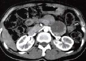 【病例】胰腺实性假乳头状瘤1例CT影像表现 【病例】胰腺实性假乳头状瘤1例CT影像表现