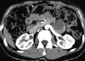 【病例】胰腺实性假乳头状瘤1例CT影像表现 【病例】胰腺实性假乳头状瘤1例CT影像表现