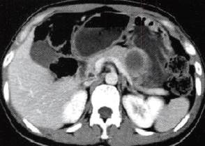 【病例】胰腺实性假乳头状瘤1例CT影像表现 【病例】胰腺实性假乳头状瘤1例CT影像表现