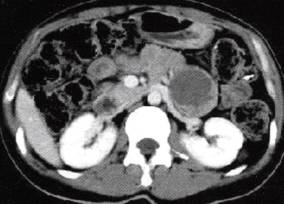 【病例】胰腺实性假乳头状瘤1例CT影像表现 【病例】胰腺实性假乳头状瘤1例CT影像表现