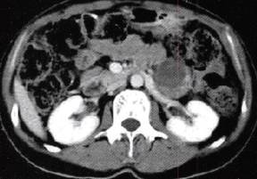 【病例】胰腺实性假乳头状瘤1例CT影像表现 【病例】胰腺实性假乳头状瘤1例CT影像表现