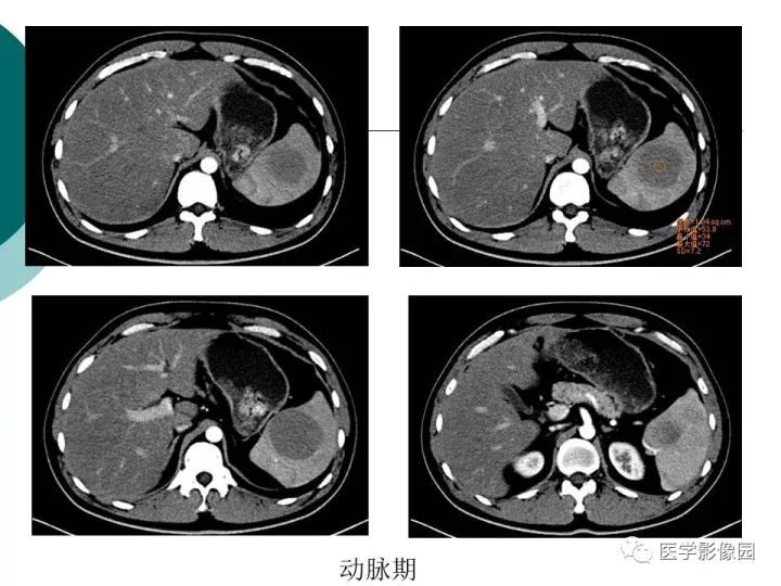 【病例】脾脏错构瘤1例CT影像表现