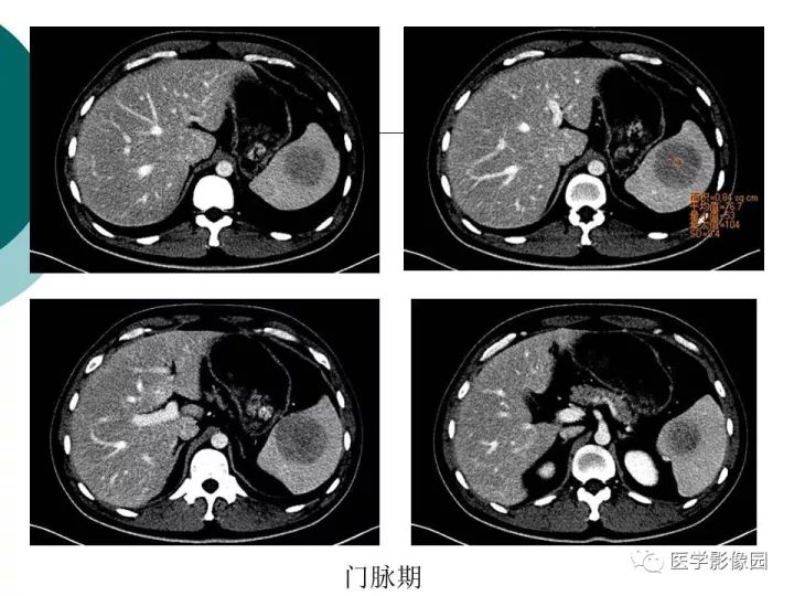 【病例】脾脏错构瘤1例CT影像表现