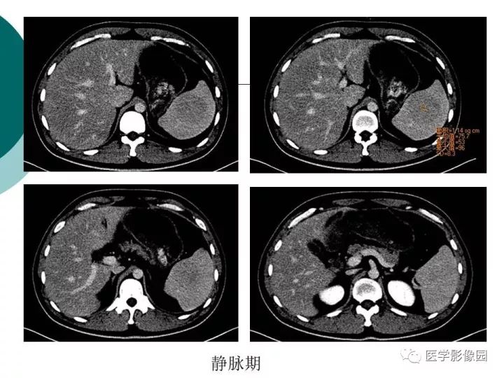 【病例】脾脏错构瘤1例CT影像表现