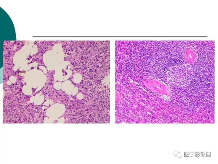 【病例】脾脏错构瘤1例CT影像表现