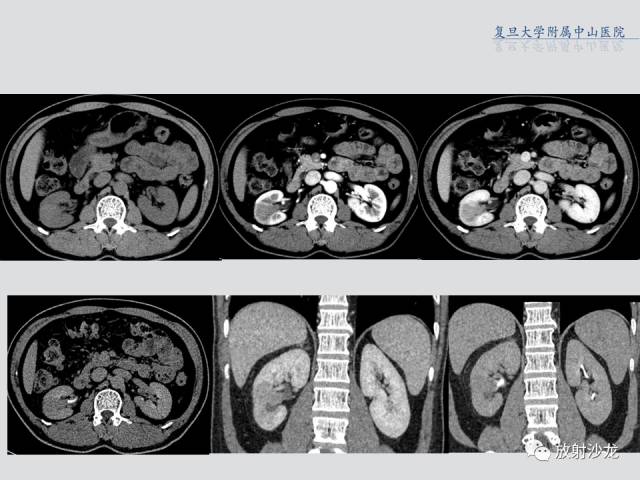 【病例】肾脏炎性假瘤1例CT