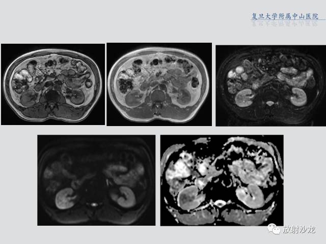 【病例】肾脏炎性假瘤1例CT