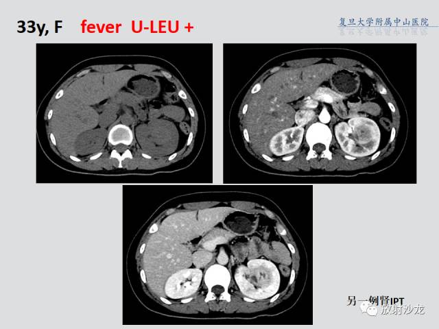 【病例】肾脏炎性假瘤1例CT