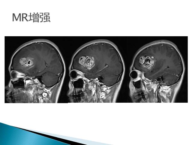 【病例】胶质母细胞瘤1例MR