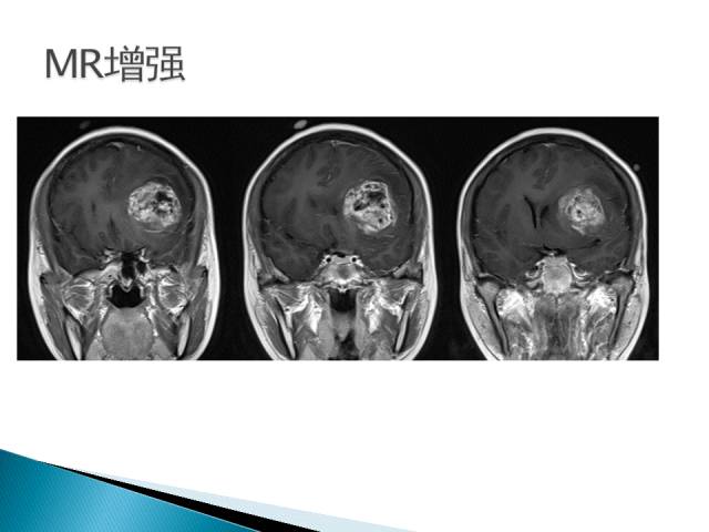 【病例】胶质母细胞瘤1例MR