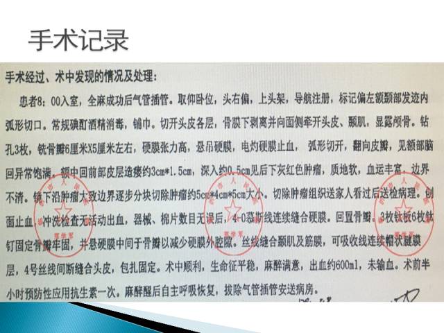 【病例】胶质母细胞瘤1例MR