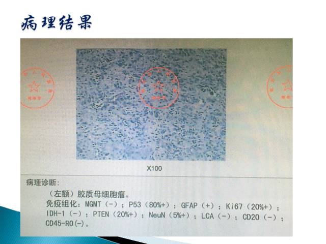 【病例】胶质母细胞瘤1例MR