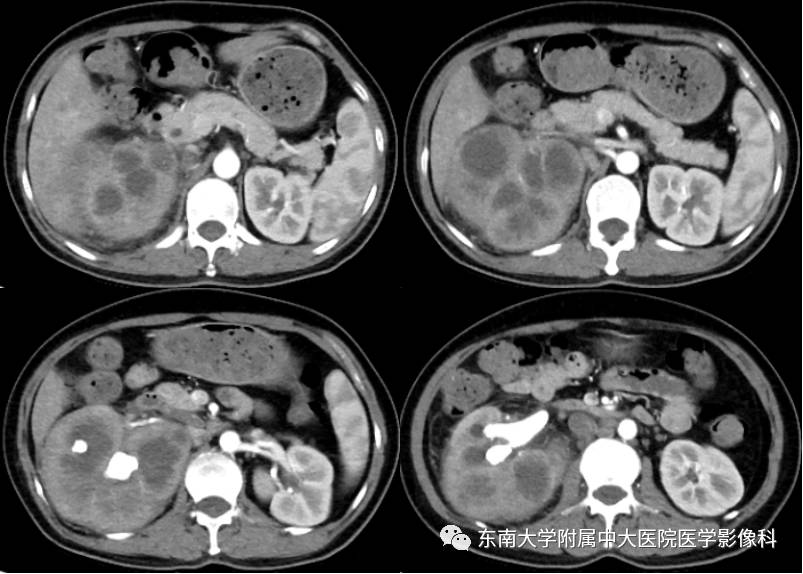 【病例】肾脏感染性病变2例CT影像诊断