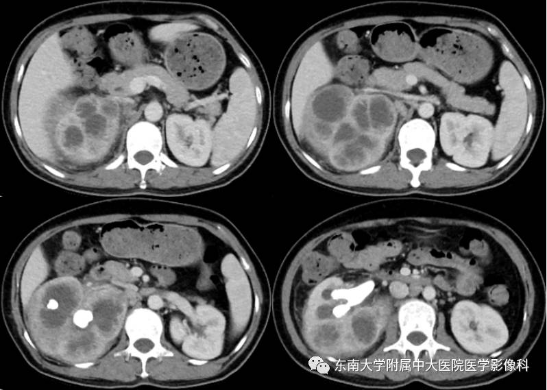 【病例】肾脏感染性病变2例CT影像诊断