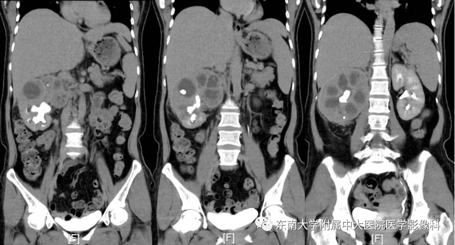 【病例】肾脏感染性病变2例CT影像诊断