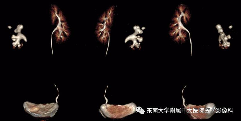 【病例】肾脏感染性病变2例CT影像诊断