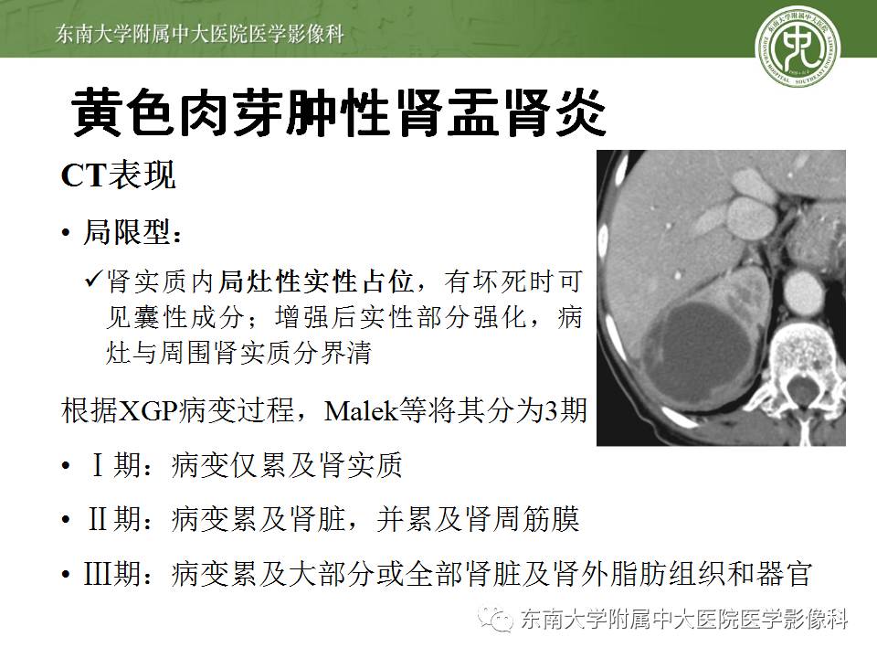 【病例】肾脏感染性病变2例CT影像诊断