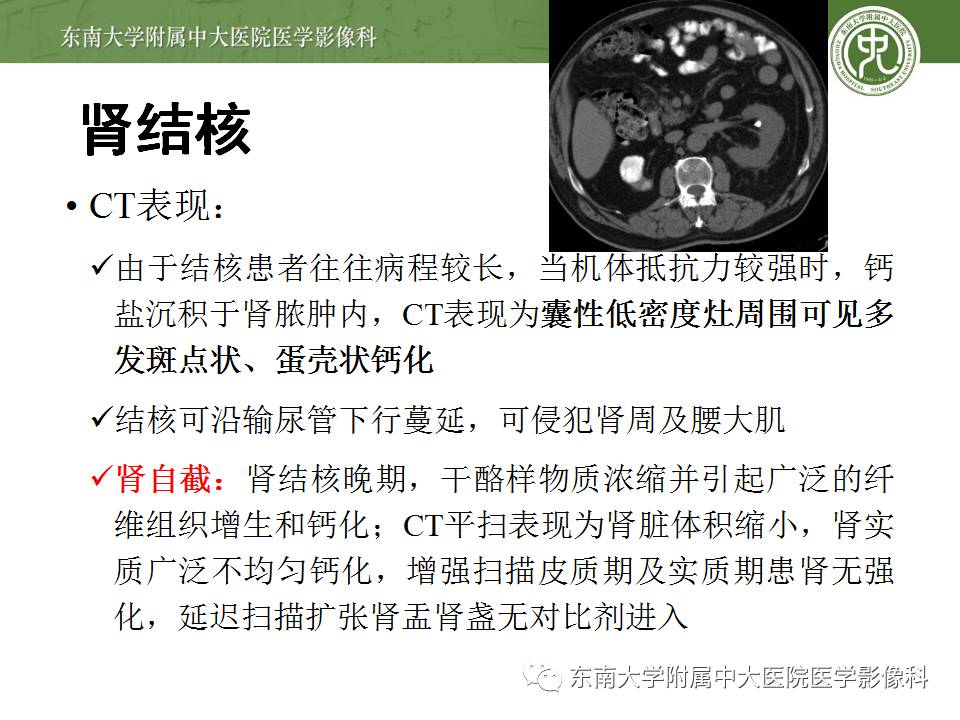 【病例】肾脏感染性病变2例CT影像诊断