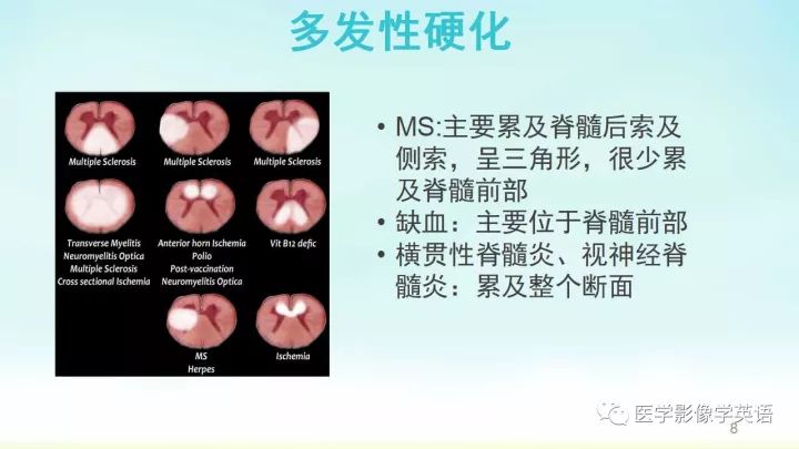【PPT】脊髓病例