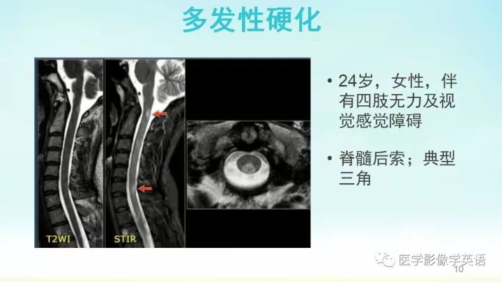 【PPT】脊髓病例