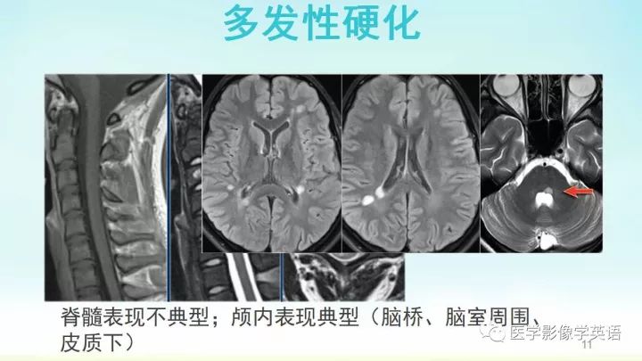 【PPT】脊髓病例