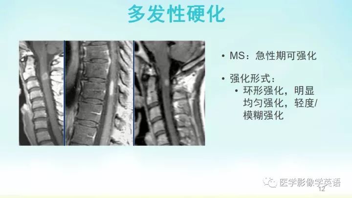 【PPT】脊髓病例