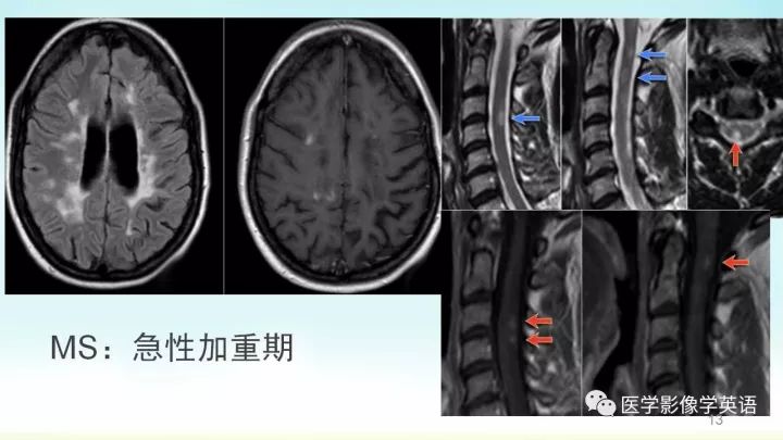 【PPT】脊髓病例